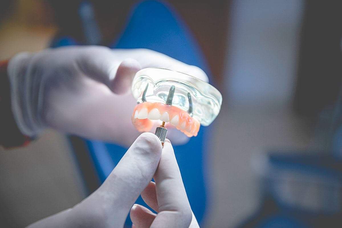 cosa sono gli impianti dentali